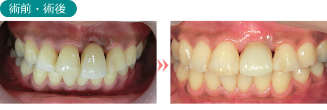 インプラント後の歯肉退縮治療1