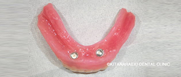 ロケーターインプラント義歯4