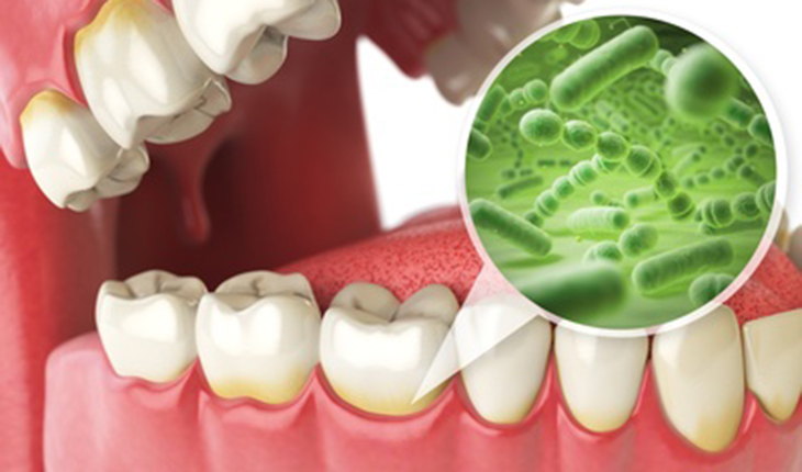 歯周病の原因菌