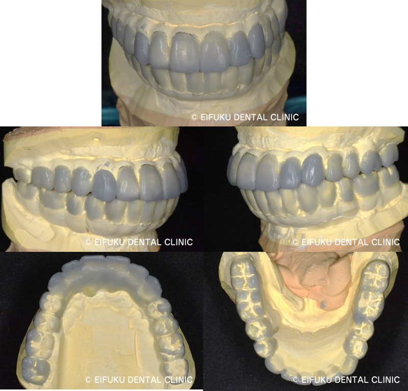ワックスアップ