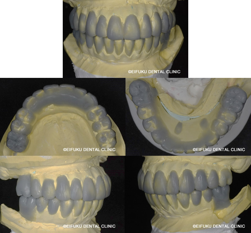ワックスアップ