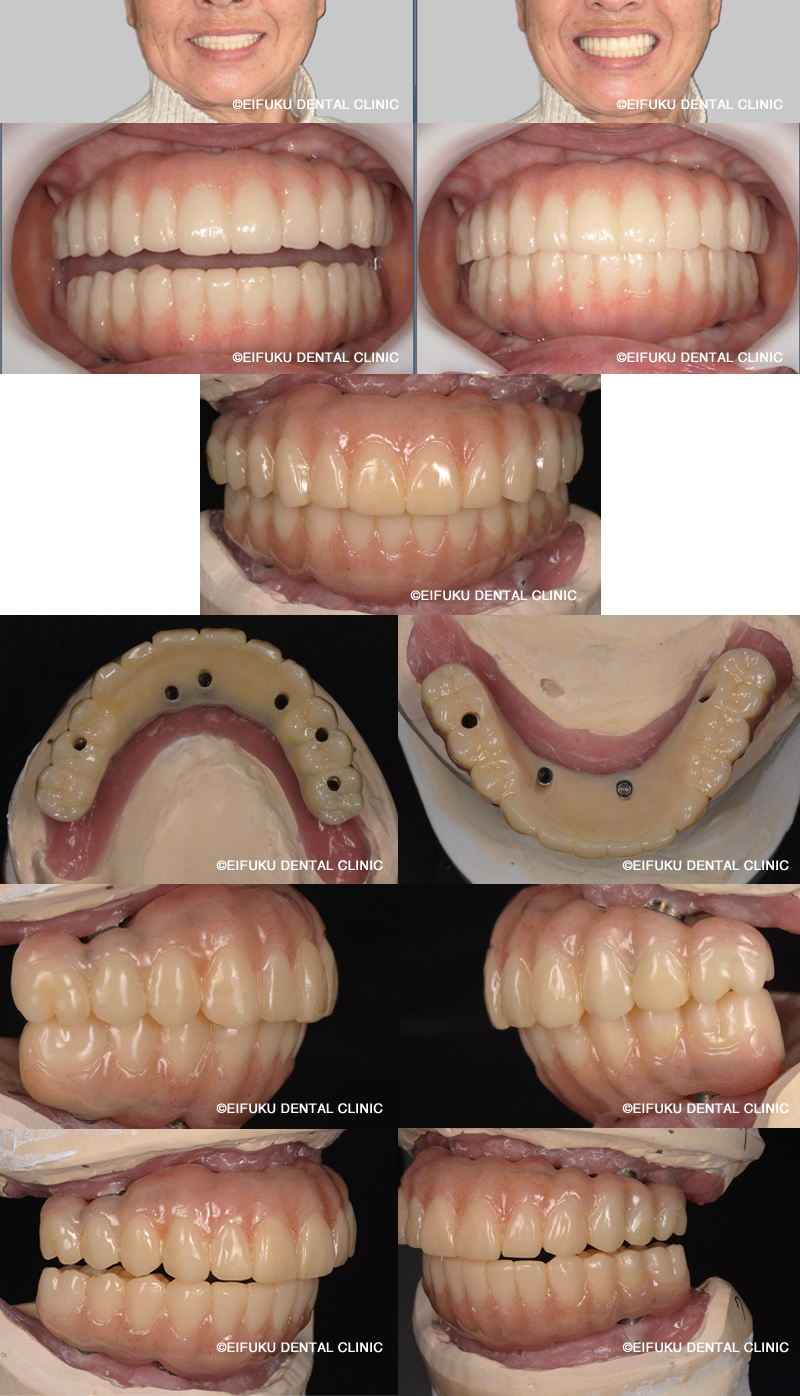 セカンドプロビジョナルセット後
