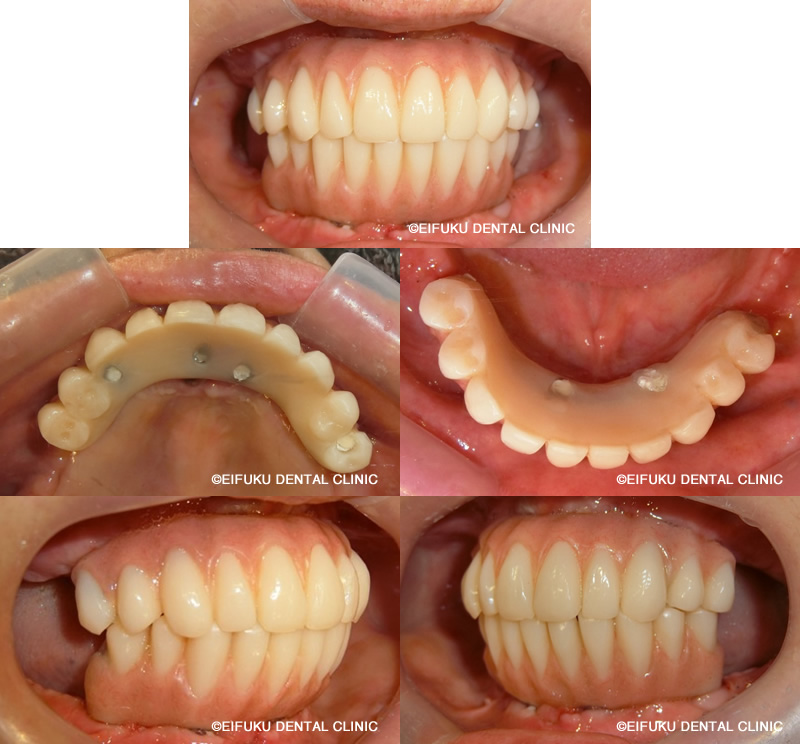 ファーストプロビジョナルセット後