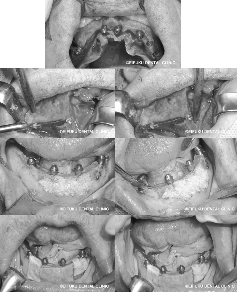 ファーストプロビジョナルセット後