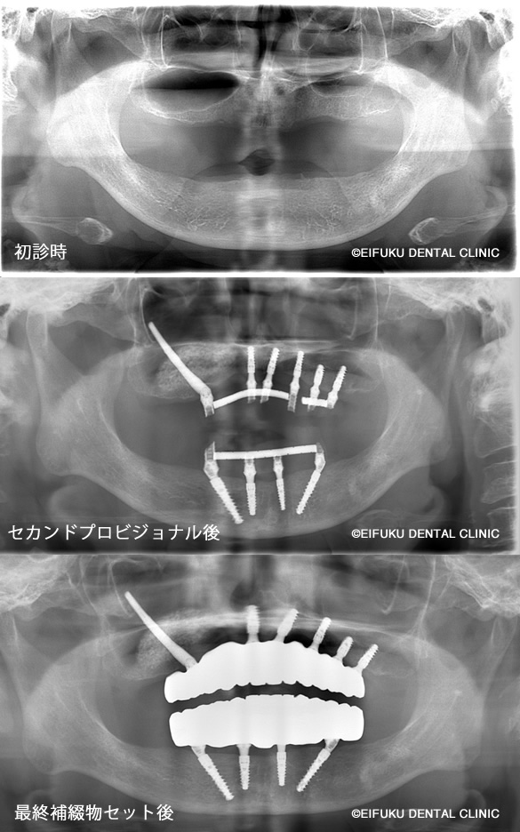 パノラマレントゲン