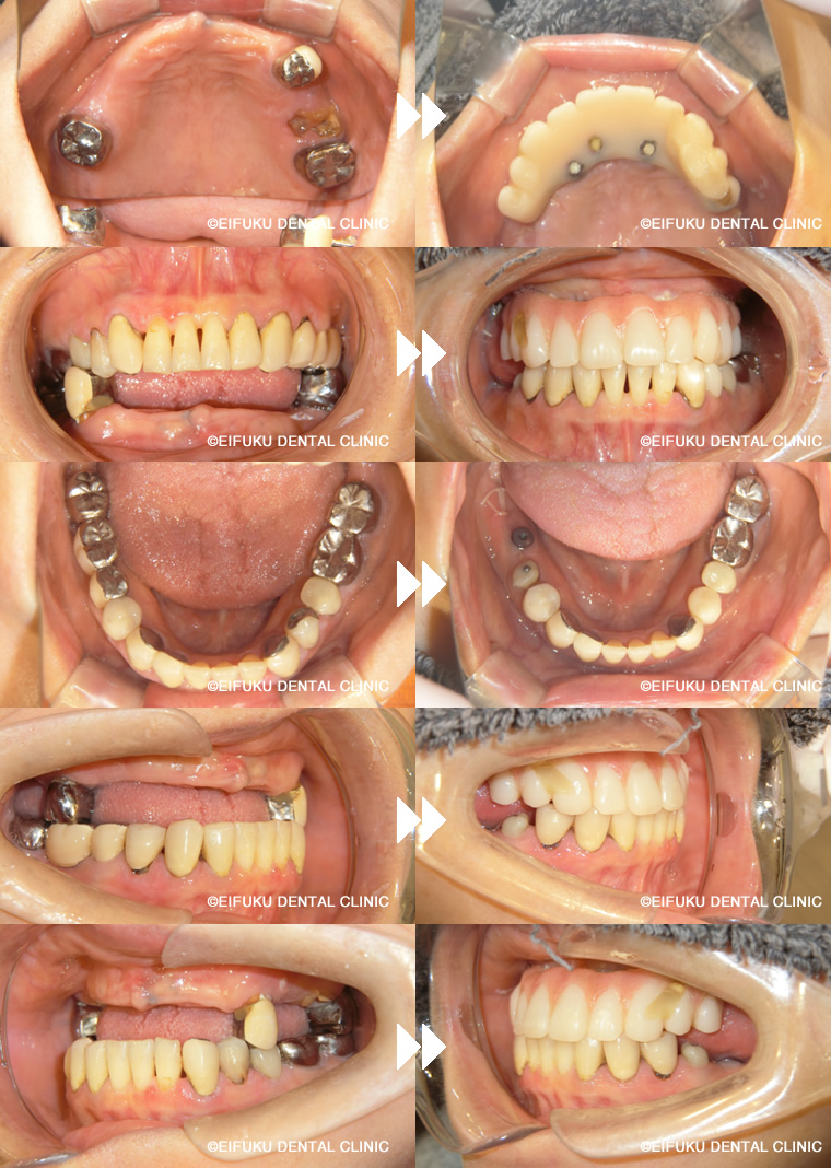 ザイゴマインプラント術前⇒術後