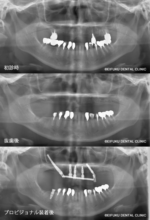 ザイゴマインプラントパノラマレントゲン