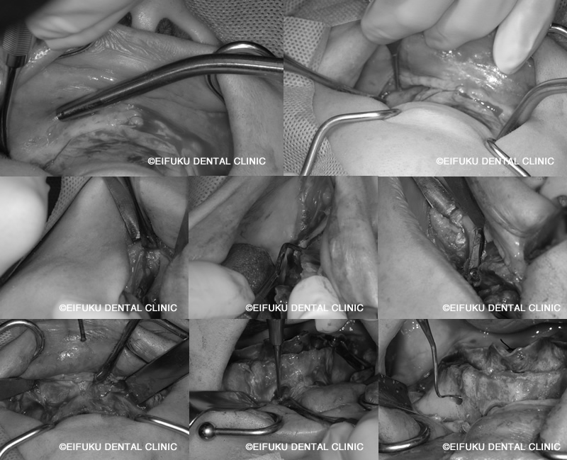 術中ザイゴマインプラント