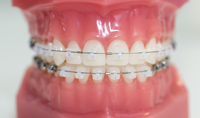 杉並区の表側装置｜永福町駅前歯科・矯正歯科・小児歯科