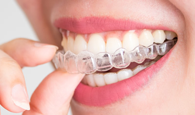 インビザライン