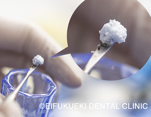 骨造成・難症例インプラント