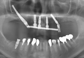 ザイゴマインプラント
