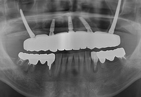 ザイゴマインプラント